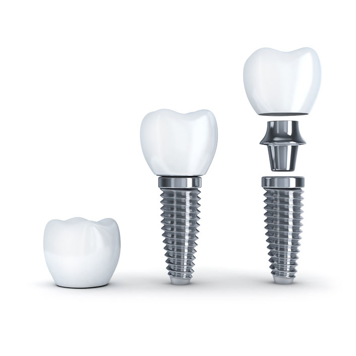 Dental Implants - Dental Services