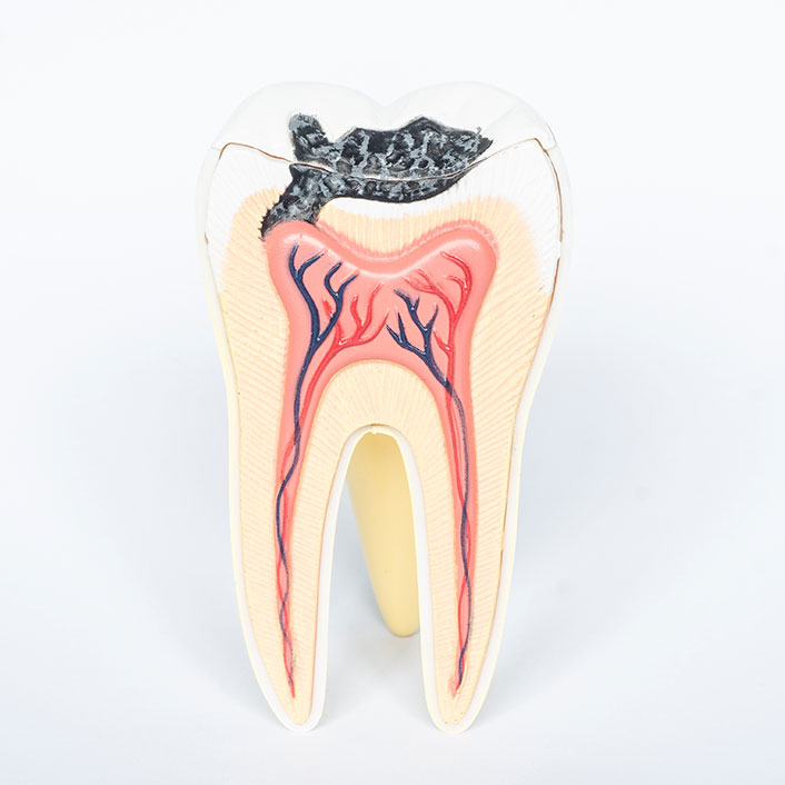 Caries Detection System - Dental Technology