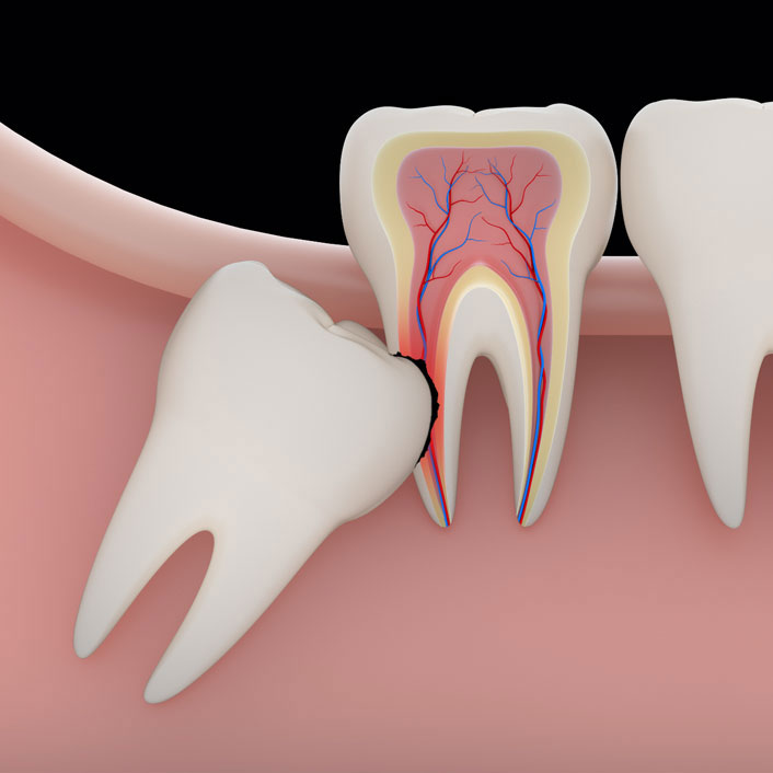 Wisdom Teeth - Dental Services